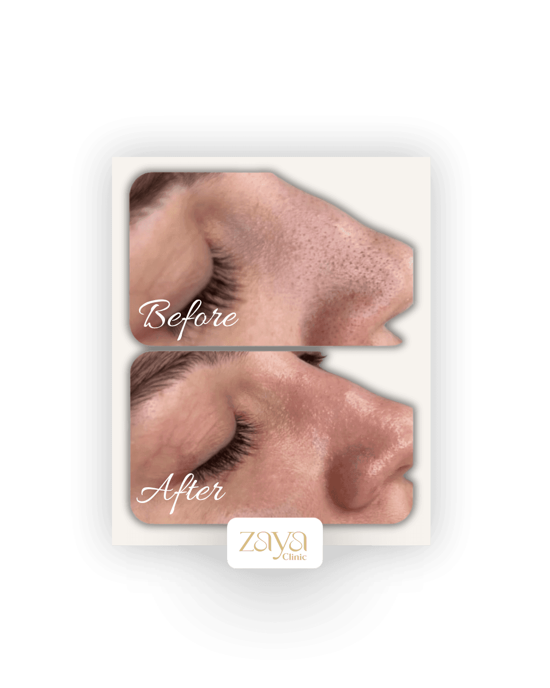 Before and after result at Zaya Clinic, Al Mizhar Dubai
