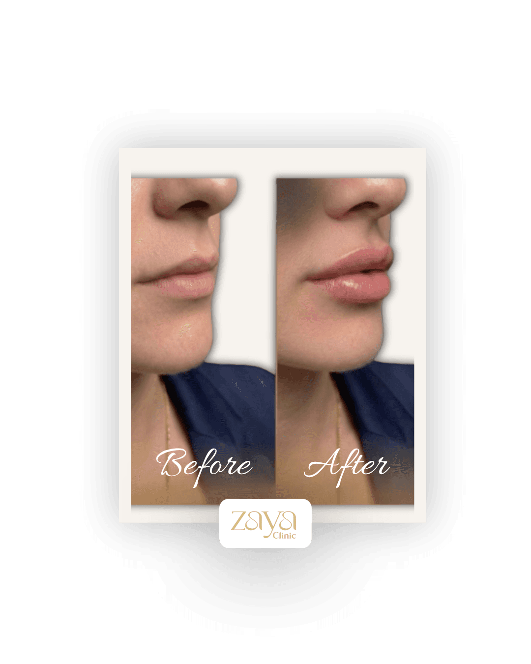Before and after result at Zaya Clinic, Al Mizhar Dubai
