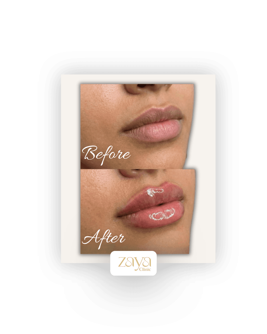 Before and after result at Zaya Clinic, Al Mizhar Dubai