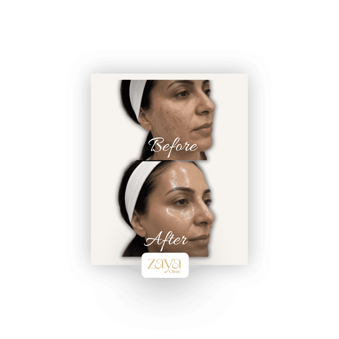 HydraFacial before and after result 2 at Zaya Clinic, Al Mizhar Dubai