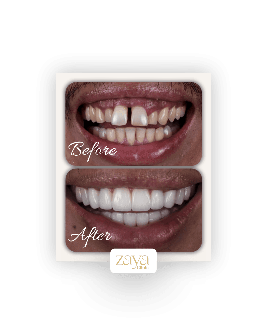 Before and after result at Zaya Clinic, Al Mizhar Dubai