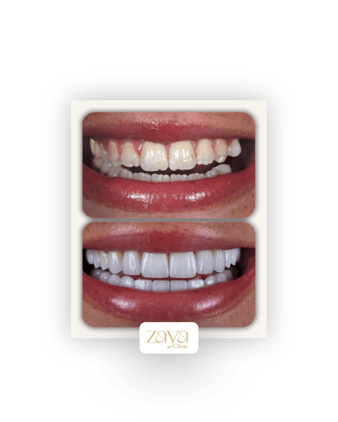 Before and after result at Zaya Clinic, Al Mizhar Dubai