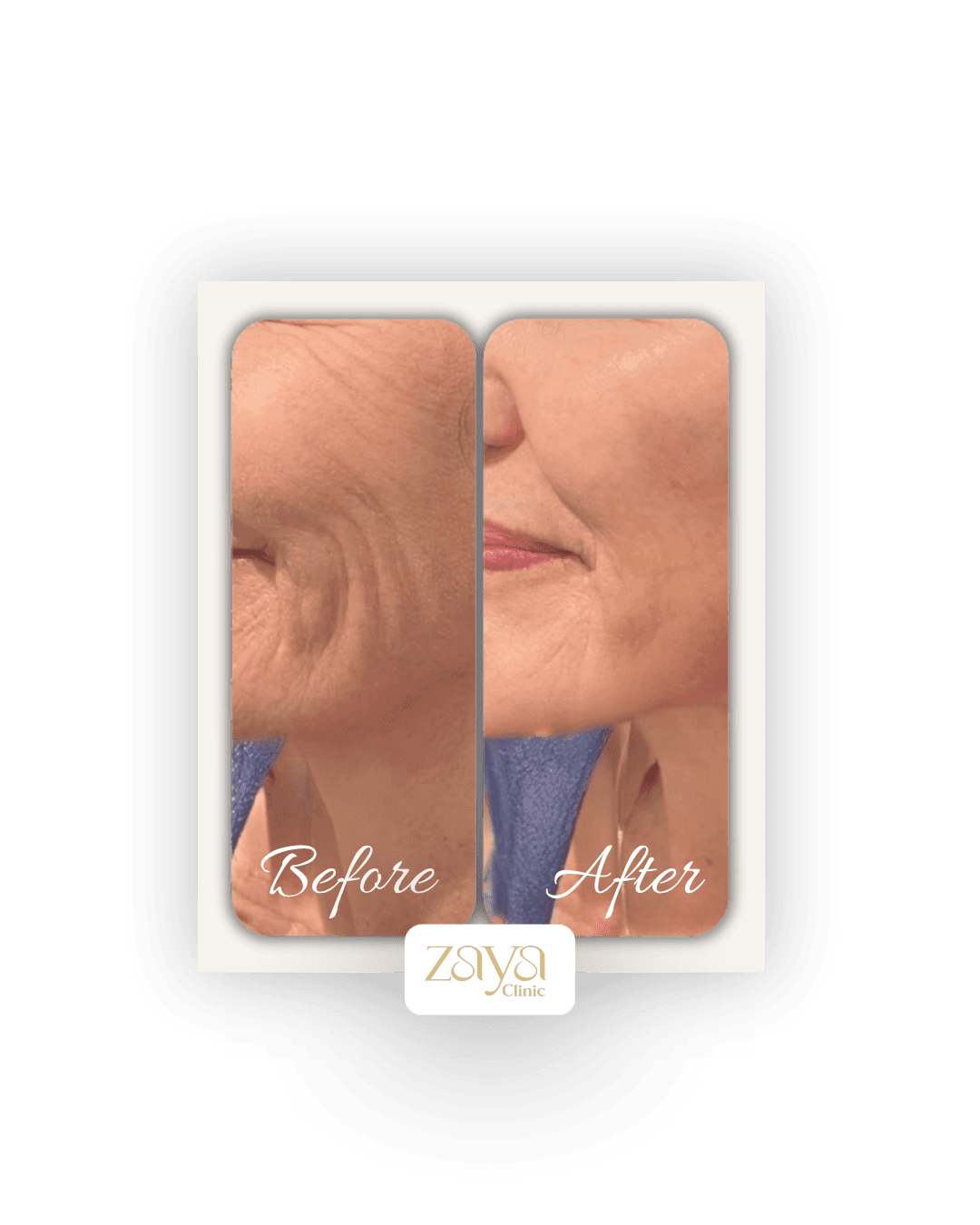 Before and after result at Zaya Clinic, Al Mizhar Dubai