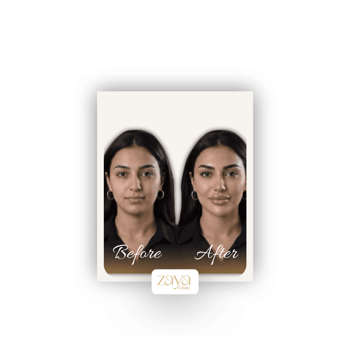 HydraFacial before and after result 1 at Zaya Clinic, Al Mizhar Dubai
