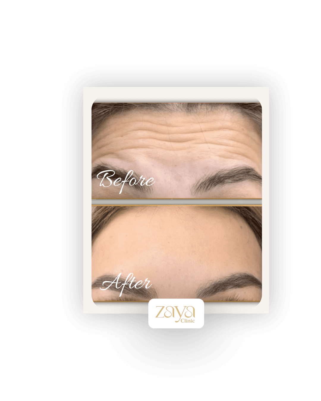 Before and after result at Zaya Clinic, Al Mizhar Dubai