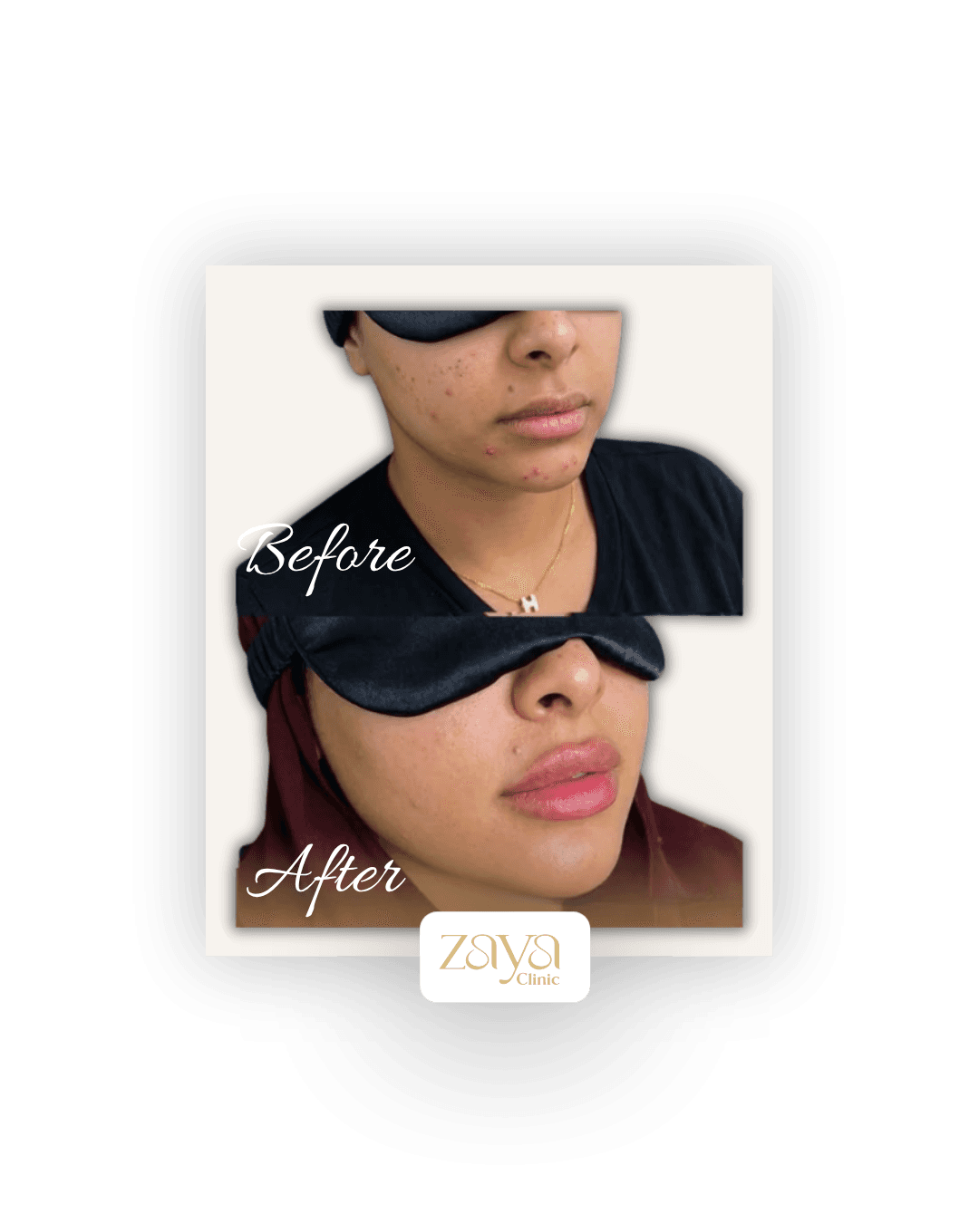 Before and after result at Zaya Clinic, Al Mizhar Dubai