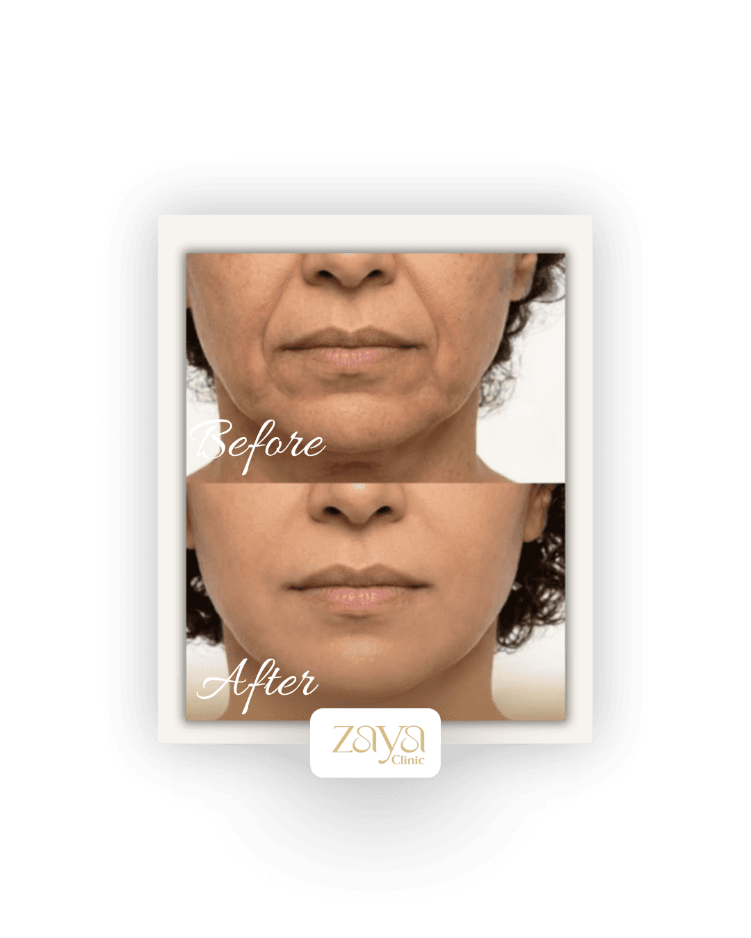 Before and after result at Zaya Clinic, Al Mizhar Dubai