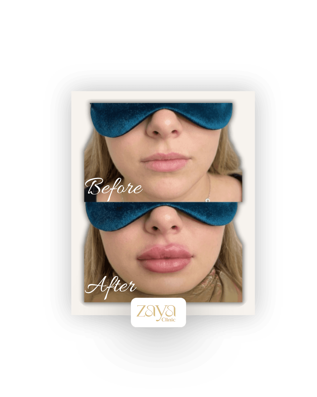 Before and after result at Zaya Clinic, Al Mizhar Dubai