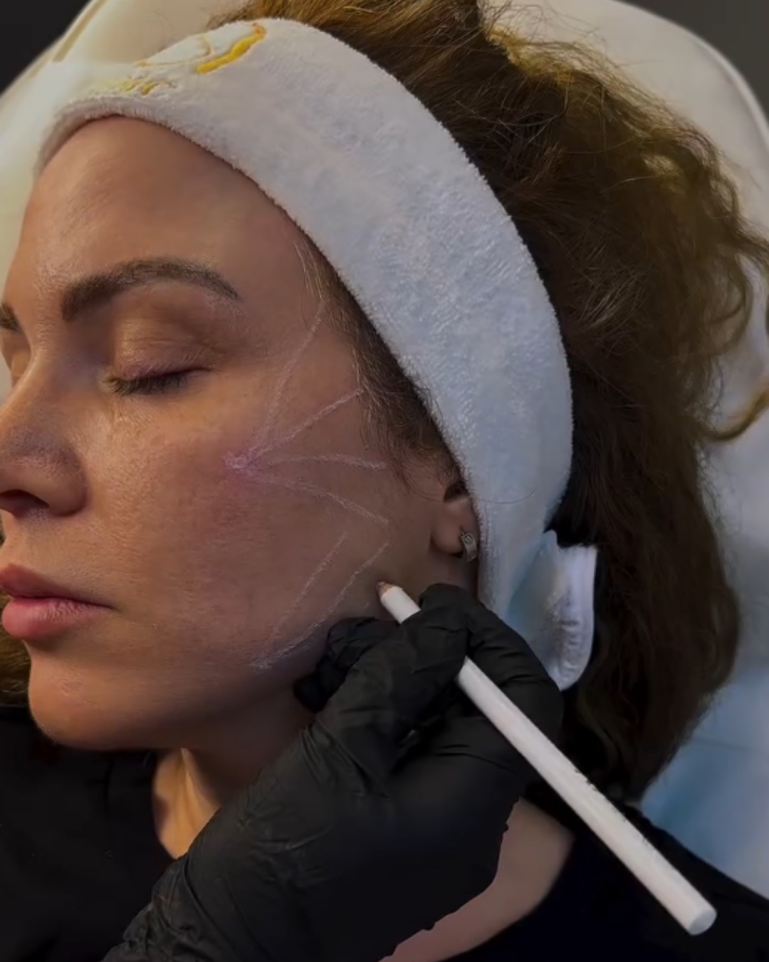 Botox treatment at Zaya Clinic, Al Mizhar Dubai