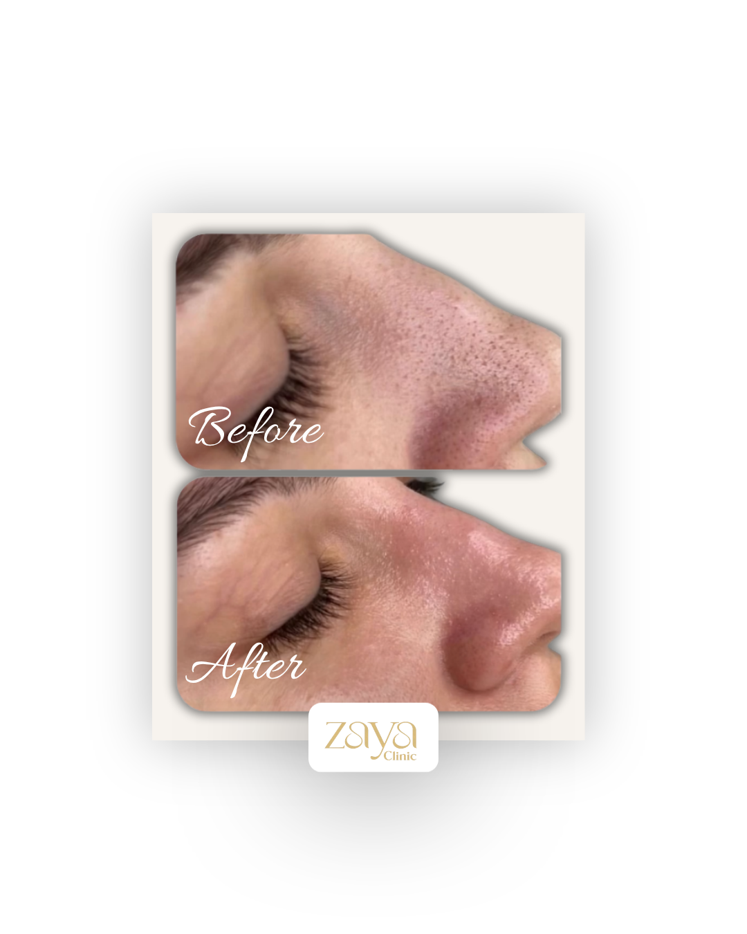 Before and after result at Zaya Clinic 1